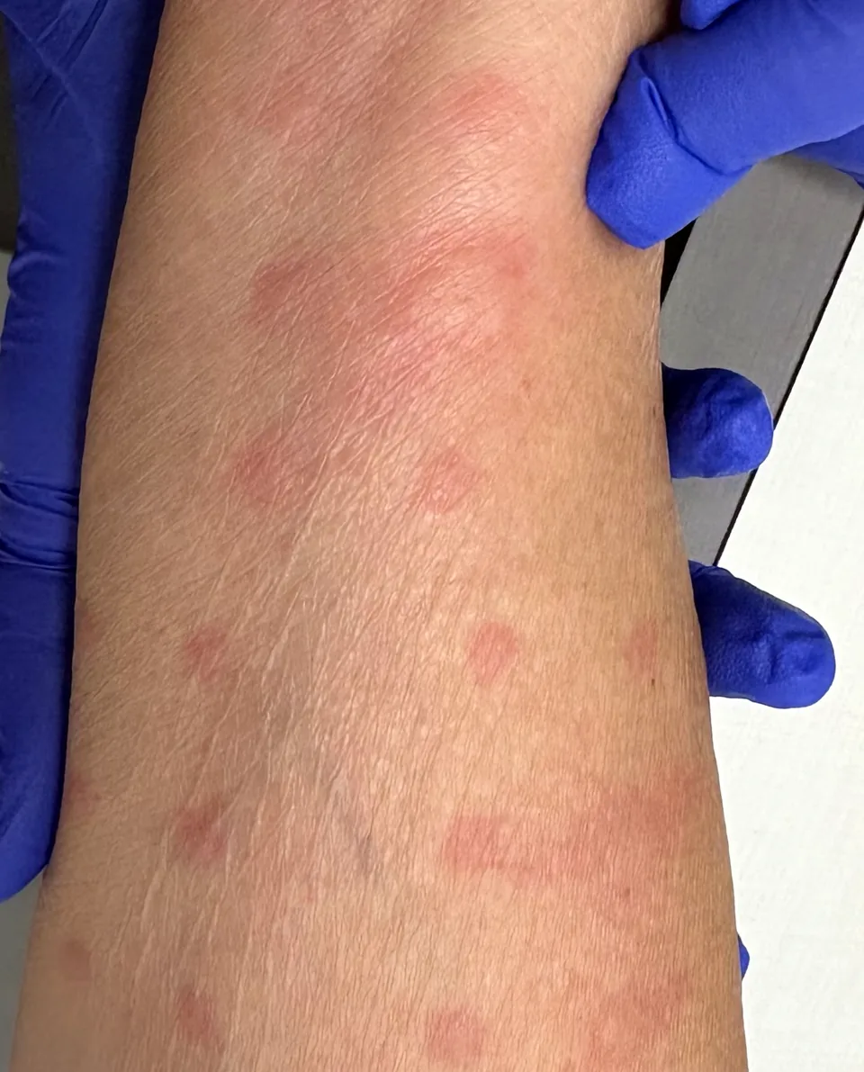 A forearm after skin testing, with round red test sites in rows while a clinician in blue gloves steadies the arm