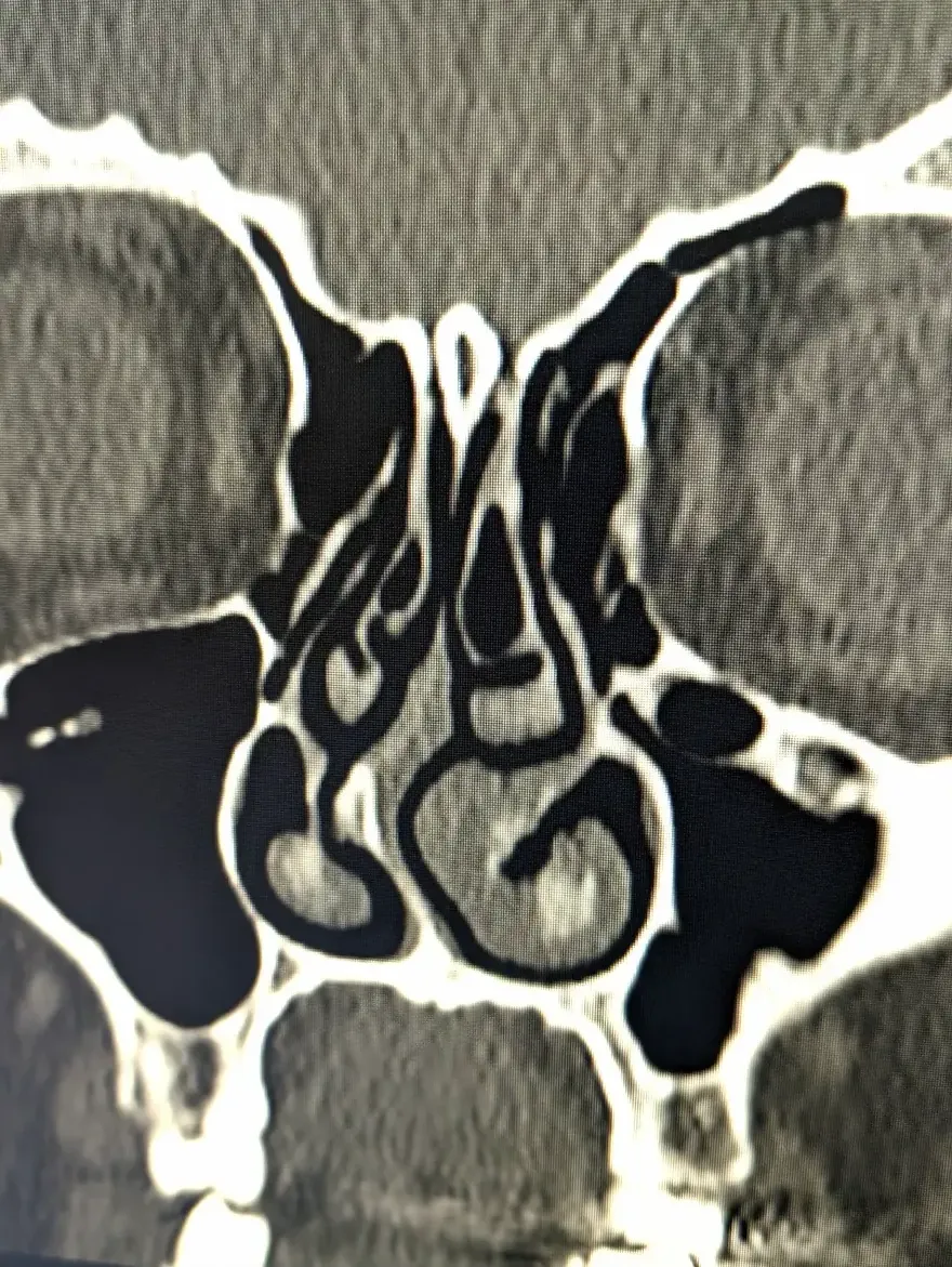 Coronal sinus CT supplied by Dr. Fewins, showing the nasal septum, turbinates and surrounding sinus spaces