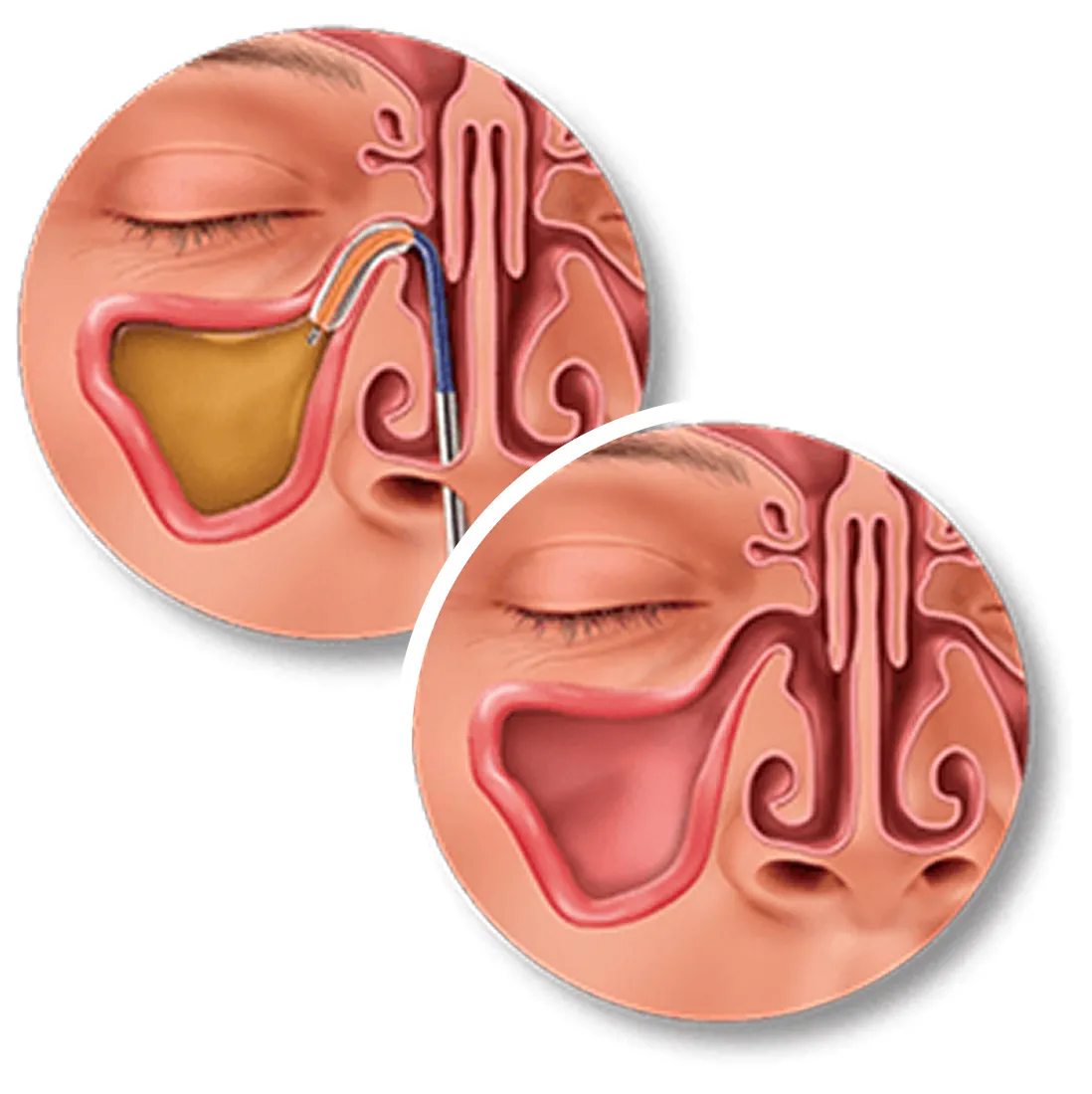 Illustration of balloon sinuplasty: a balloon catheter opening a blocked, infected maxillary sinus, and the same sinus draining afterward