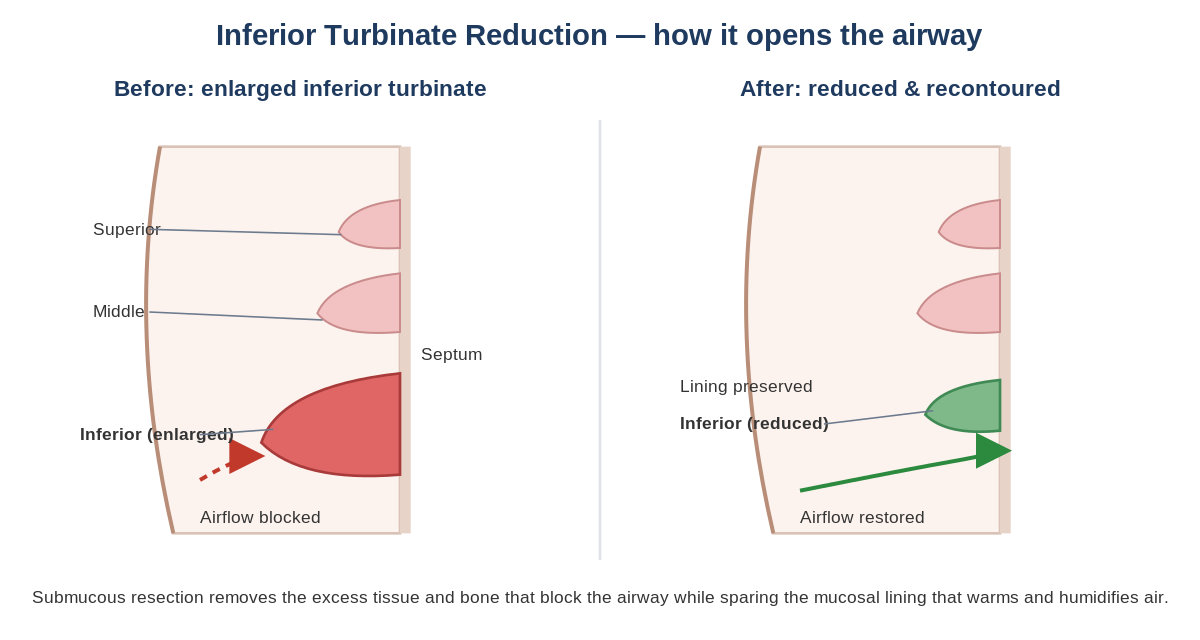 Before and after illustration of inferior turbinate reduction in Fort Worth: an enlarged inferior turbinate obstructing the nasal airway, and an open nasal airway with restored airflow after reduction